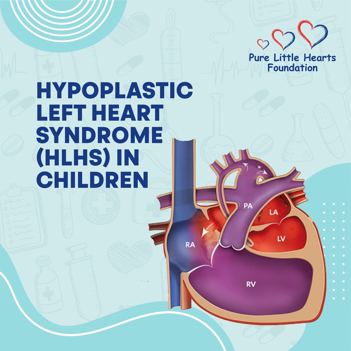 PLHFfoundation's tweet photo. #PureLittleHeartsFoundation #HLHSAwareness #ChildHealth #HypoplasticLeftHeartSyndrome #HeartHealth #SavingLittleHearts #PediatricCardiology https://t.co/fmVmIqiQEJ
