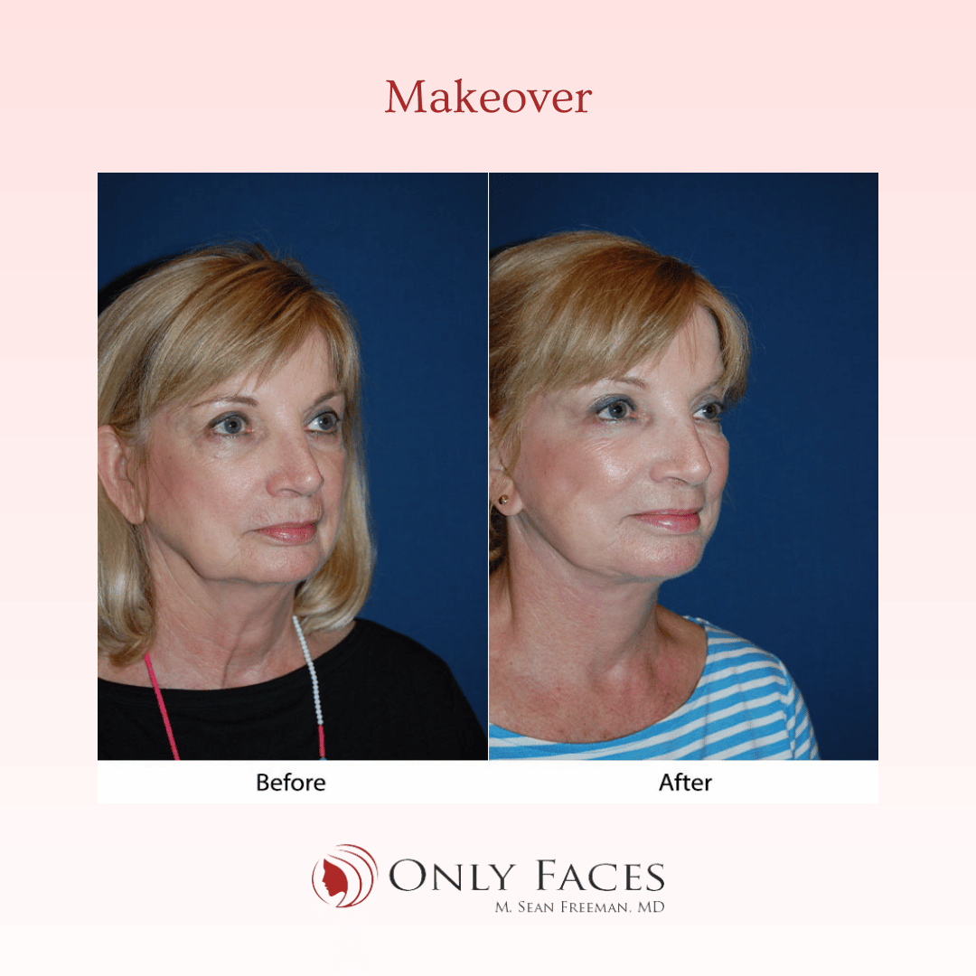 OnlyFacesCLT's tweet photo. This 65-year-old is two months post-op from a Segmental Endoscopic #BrowLift: 3/4-R, lateral-L, Deep Plane #MiniTuck, Lower Lid: SOOF lift #blepharoplasty, #NeckLift and Ablative CO2 Laser Resurfacing of eyes and mouth. #OnlyFaces https://t.co/oR18DgkIT5
