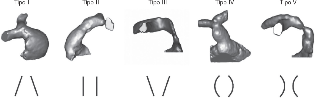 RevEspCardiol's tweet image. Implante valvular pulmonar percutáneo en tracto de salida nativo: ¿ha llegado el momento? #recintervcardiol #AheadOfPrint recintervcardiol.org/es/editorial/i…