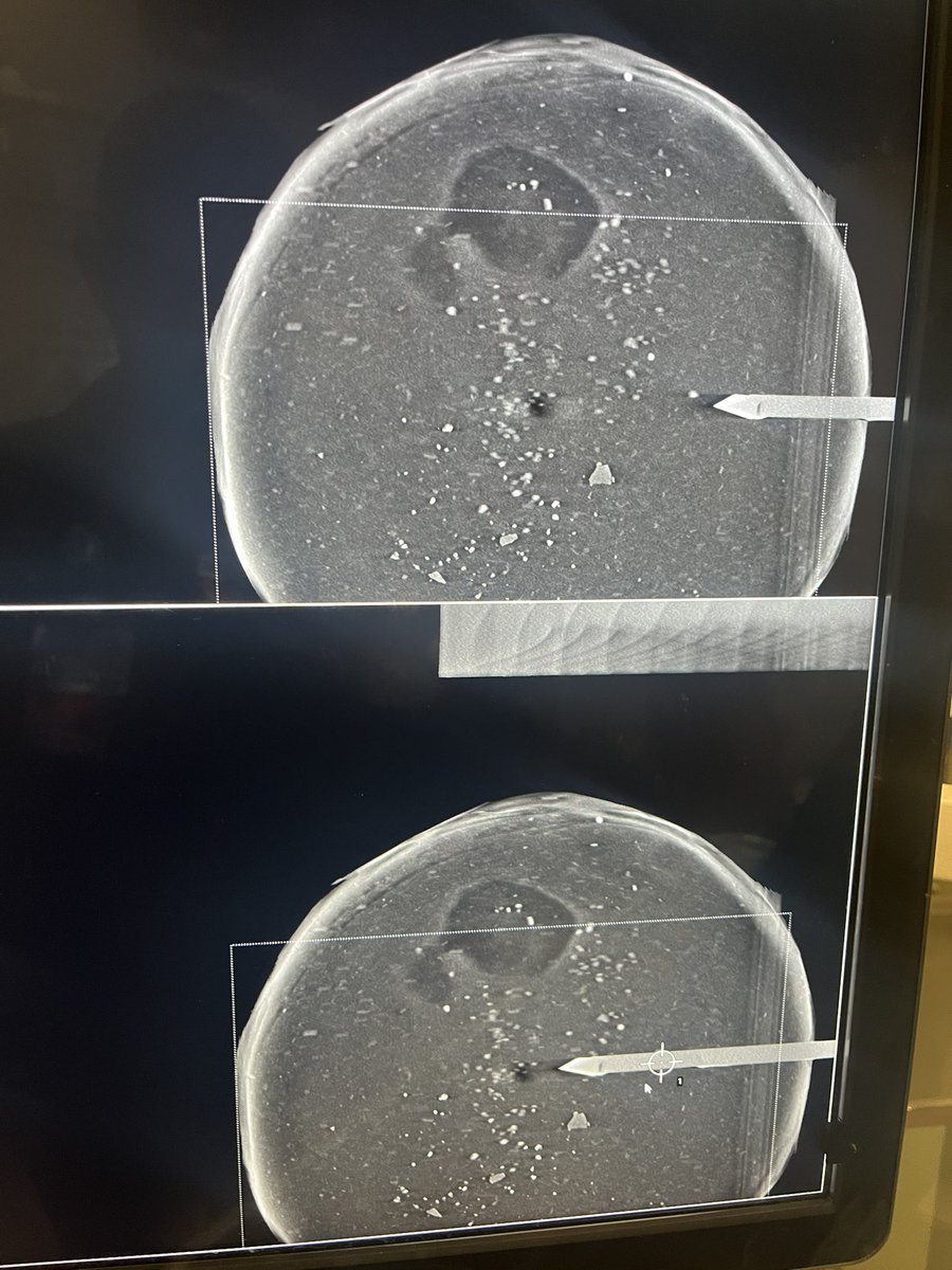 Josh Weinstein (@joshweinsteinmd) on Twitter photo Performing a stereotactic breast biopsy on a bologna. Probably not necessary though, the patient was already cured <a href="/BURadiology/">BU Radiology</a> Performing a stereotactic breast biopsy on a bologna. Probably not necessary though, the patient was already cured <a href="/BURadiology/">BU Radiology</a>