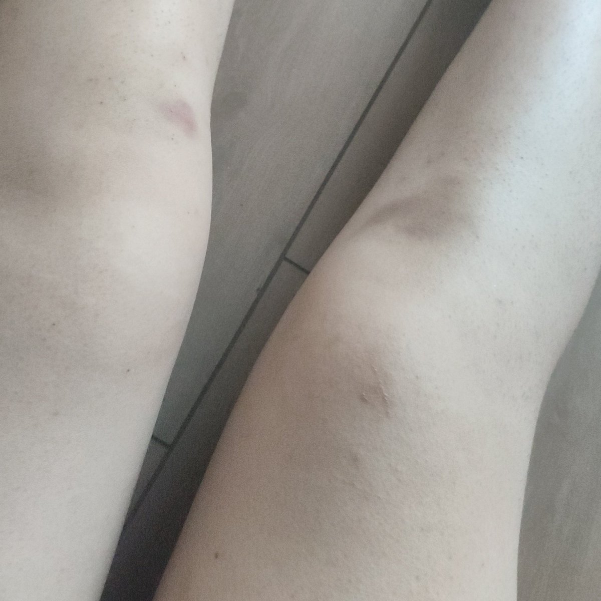 rinisita_idk's tweet photo. Cuando eran pequeños #moretones #bruises https://t.co/2NpmZ1epLc
