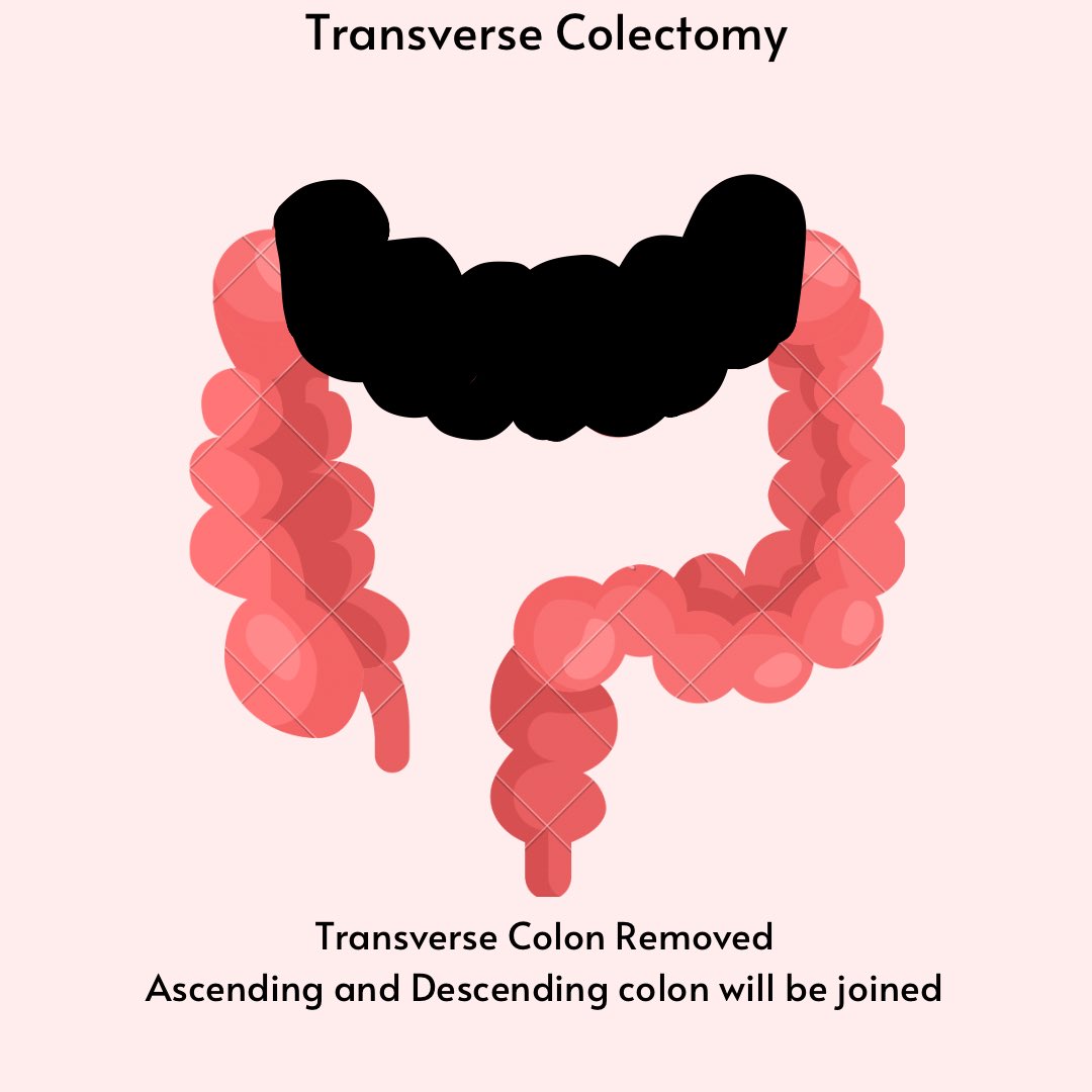 AnnelieShaw's tweet photo. Before we can understand nutritional ramifications surgery of large intestine has, we need to understand what has been removed and what has been left inside. adapted from my own hand drawn notes when I was teaching students as a surgical dietitian. #meded @trust_indi https://t.co/4JUCUIhuNo