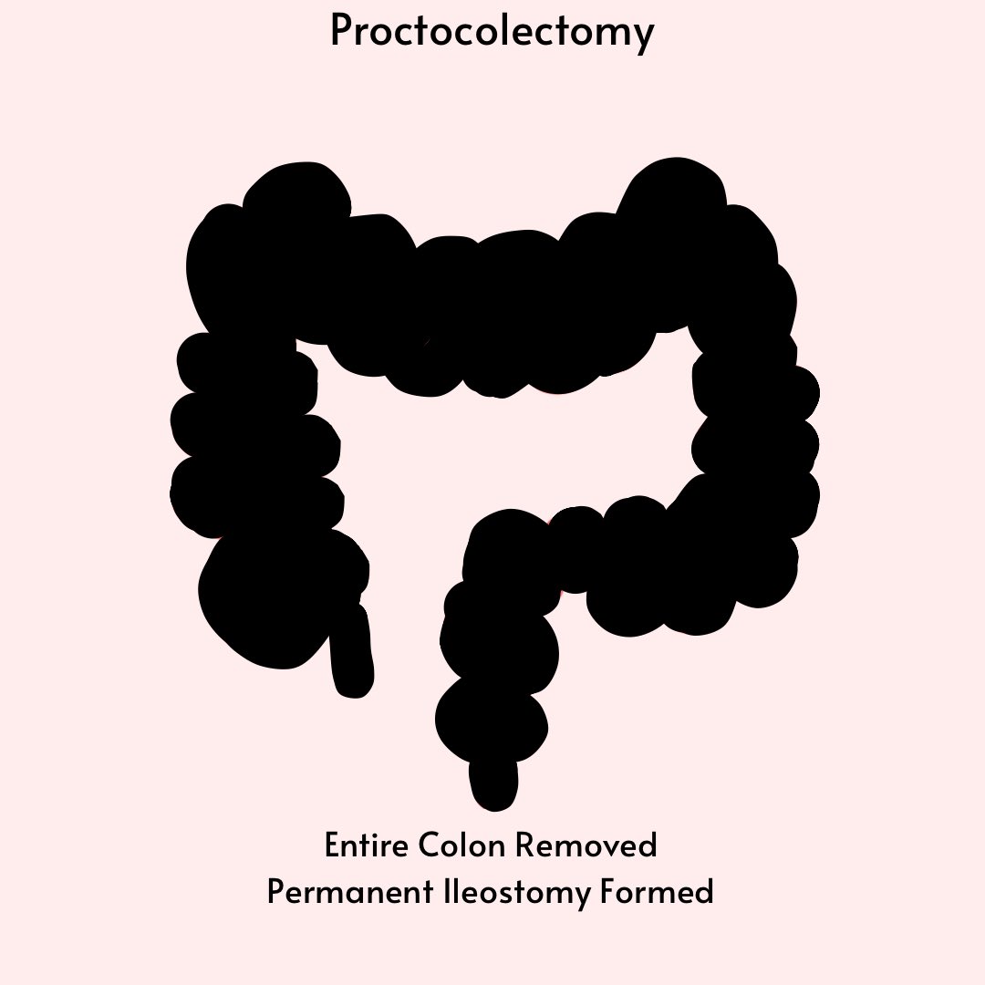AnnelieShaw's tweet photo. Before we can understand nutritional ramifications surgery of large intestine has, we need to understand what has been removed and what has been left inside. adapted from my own hand drawn notes when I was teaching students as a surgical dietitian. #meded @trust_indi https://t.co/4JUCUIhuNo