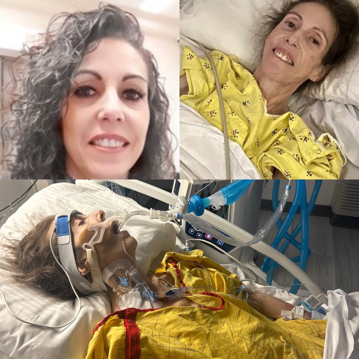 canindependent's tweet photo. Nevada woman who fought for her life for two years in the hospital after the Covid-19 vaccine passes away, leaving behind $7.5 million in hospital bills that have bankrupted her family.

The woman's teenage son says, Tonja Marie Johnson was a 57-year-old employed by the state of Nevada and was mandated to get the Covid-19 vaccine. After she received the Johnson and Johnson vaccine, she would spend the next two years fighting for her life of an unknown illness in the hospital after she became paralyzed from the waist down, developed blood clots in her legs and lungs, required the complete removal of her stomach and spleen, flatlined 4 times and was brought back to life, and dropped to just 70 lbs.” Sadly, she has now passed away.

According to the son, his mother's hospital stay racked up $7.5 million in bills, and although insurance has covered most of it, the balance has bankrupted the family.

https://t.co/9FT5fFtl9H
