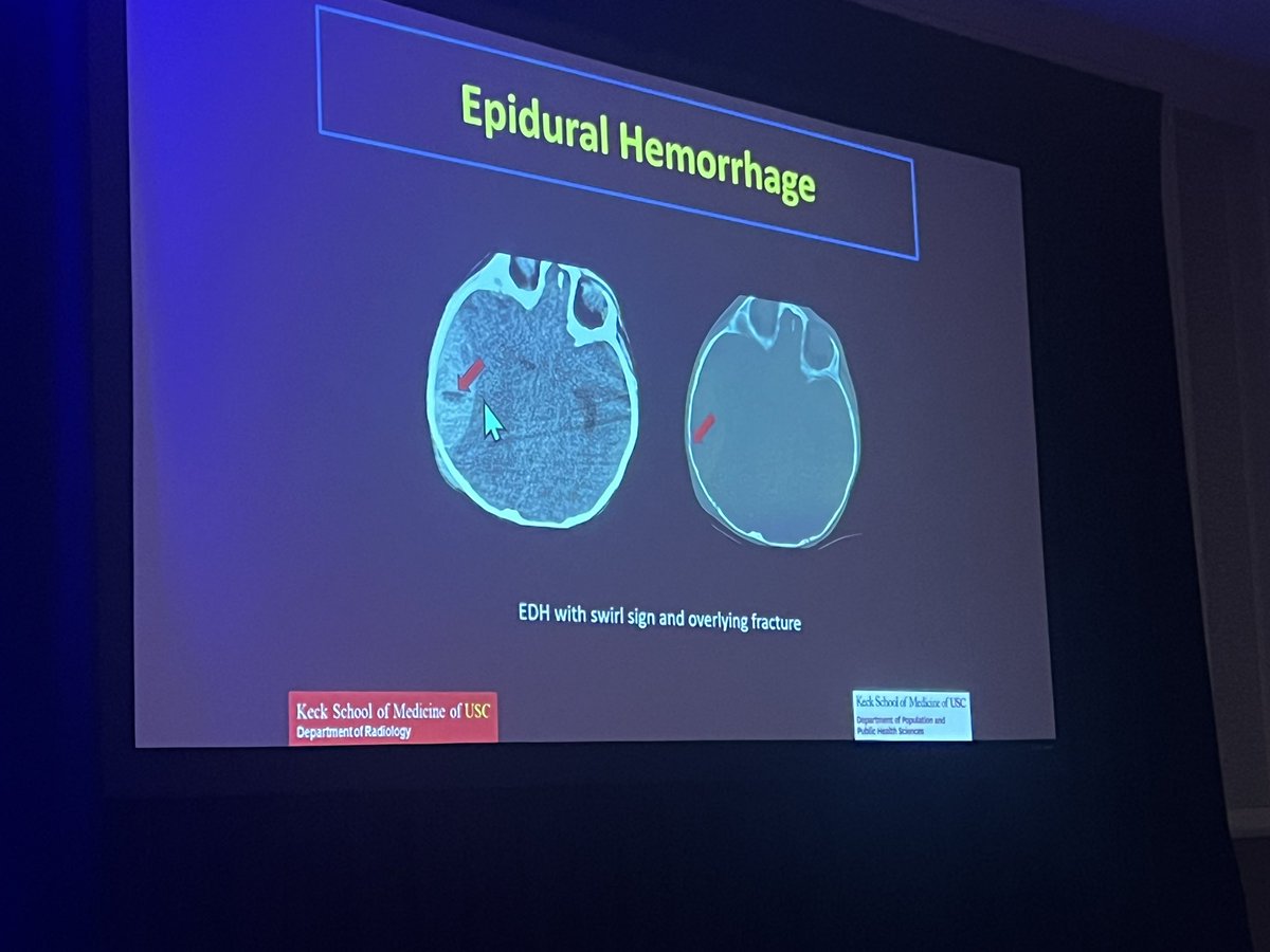 Dr Mark Shiroishi teaching us all about pediatric head trauma in the #corecurriculum at #ASPNR24 #pedineurorad @KECKSchool_USC