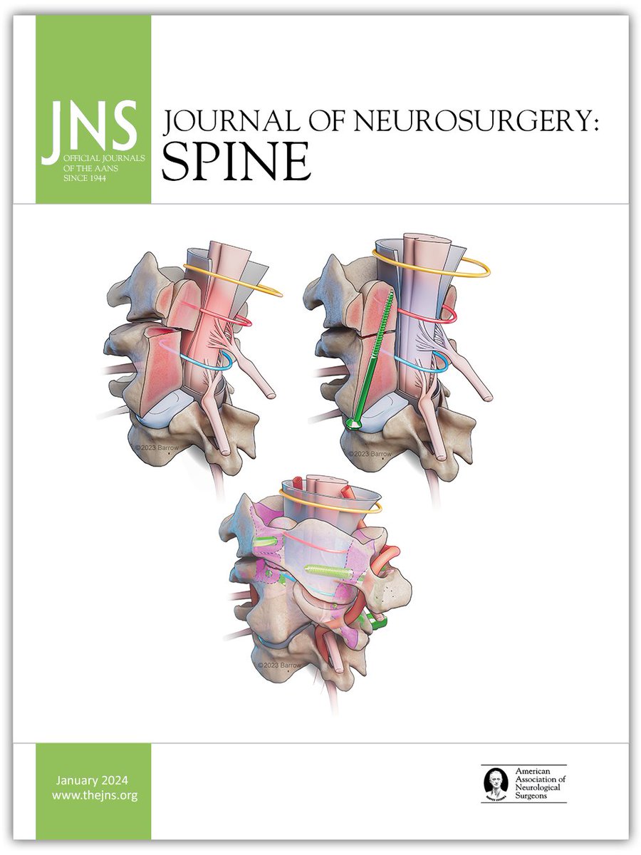 A Barrow #medicalillustration was selected for the cover of <a href="/TheJNS/">Journal of Neurosurgery</a>: #Spine! Created by Joshua Lai, it accompanies an article on nonoperative vs operative management of type II #odontoidfracture. Drs. Tumialán, Farber, &amp; Rabah are among the authors: bar.rw/3vsXBX3