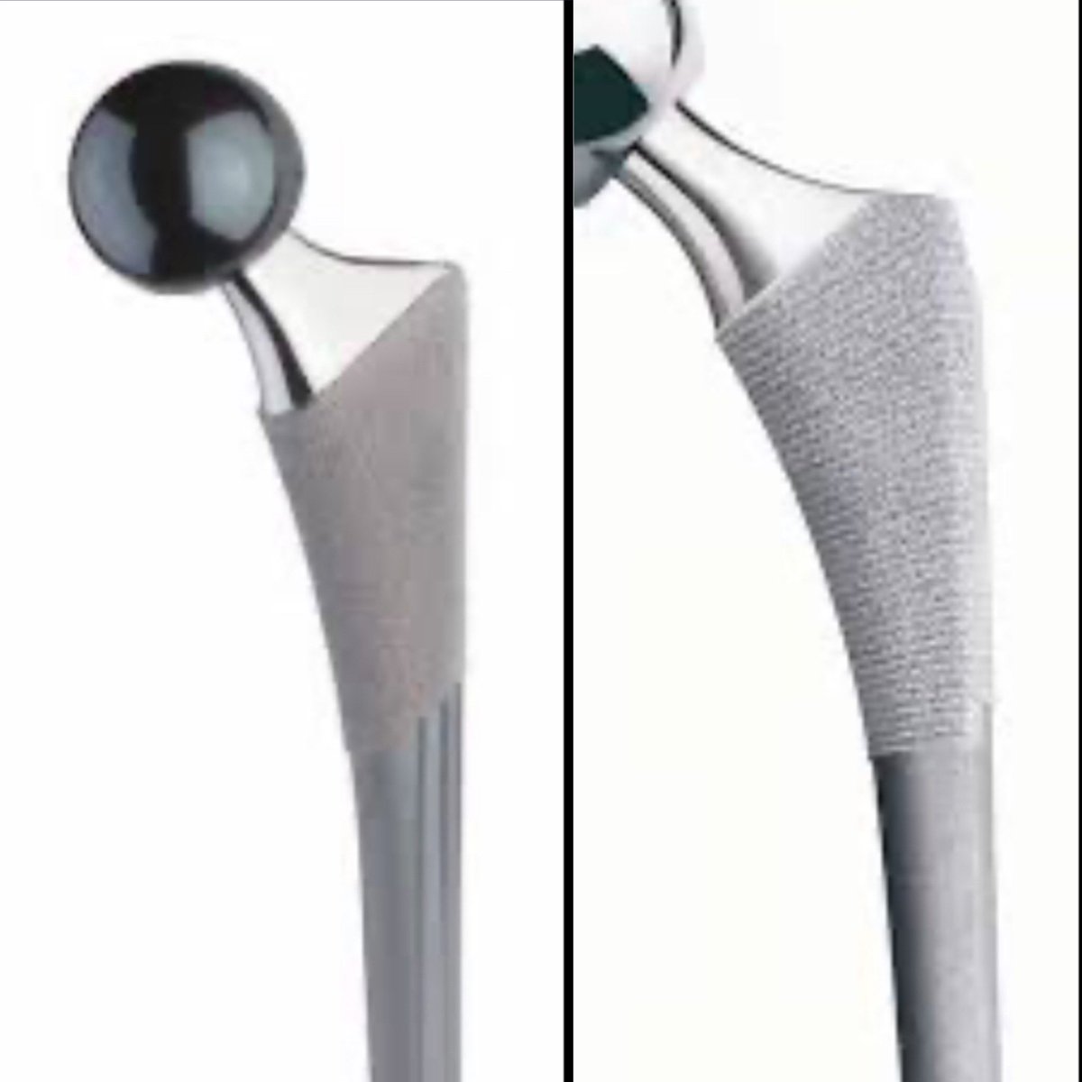 danielchanortho's tweet photo. @generalorthomd @aschwartz45 @CenterRotation @drsebheaven @ChrisGraysonMD1 Synergy - it has a horizontal shoulder and the distal porous coating is oblique.  Summit has more rounded shoulder and transverse distal end of porous coating.  Correct both 12/14 https://t.co/4H6VeRSFlQ