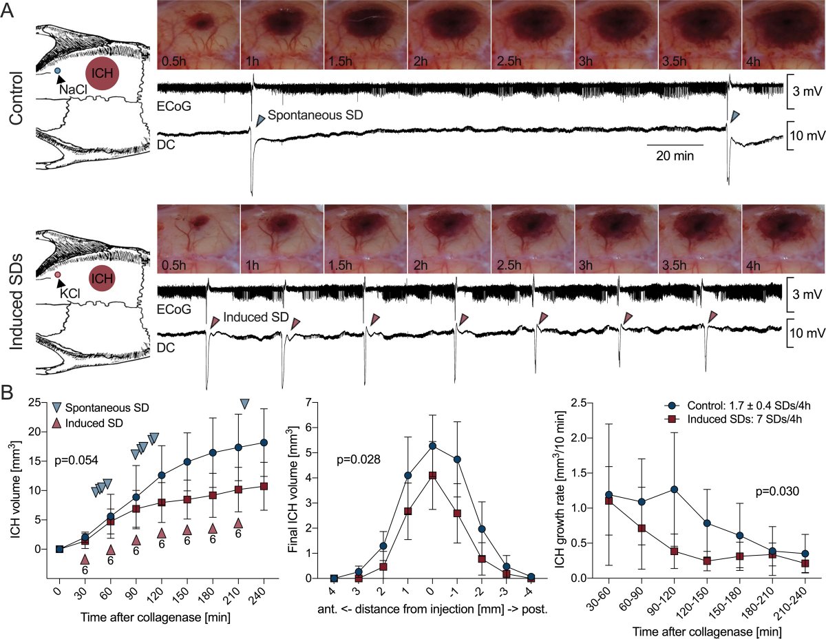 Overthrowing Dogma: Could Spreading Depolarizations Be Beneficial for Patients With Intracerebral Hemorrhage? ahajournals.org/do/10.1161/blo… ICYMI: Check out this #BloggingStroke post by @WSheaWright1 on #Stroke article by Fischer et al. @nvr_mgh @ExpNeuroBerlin