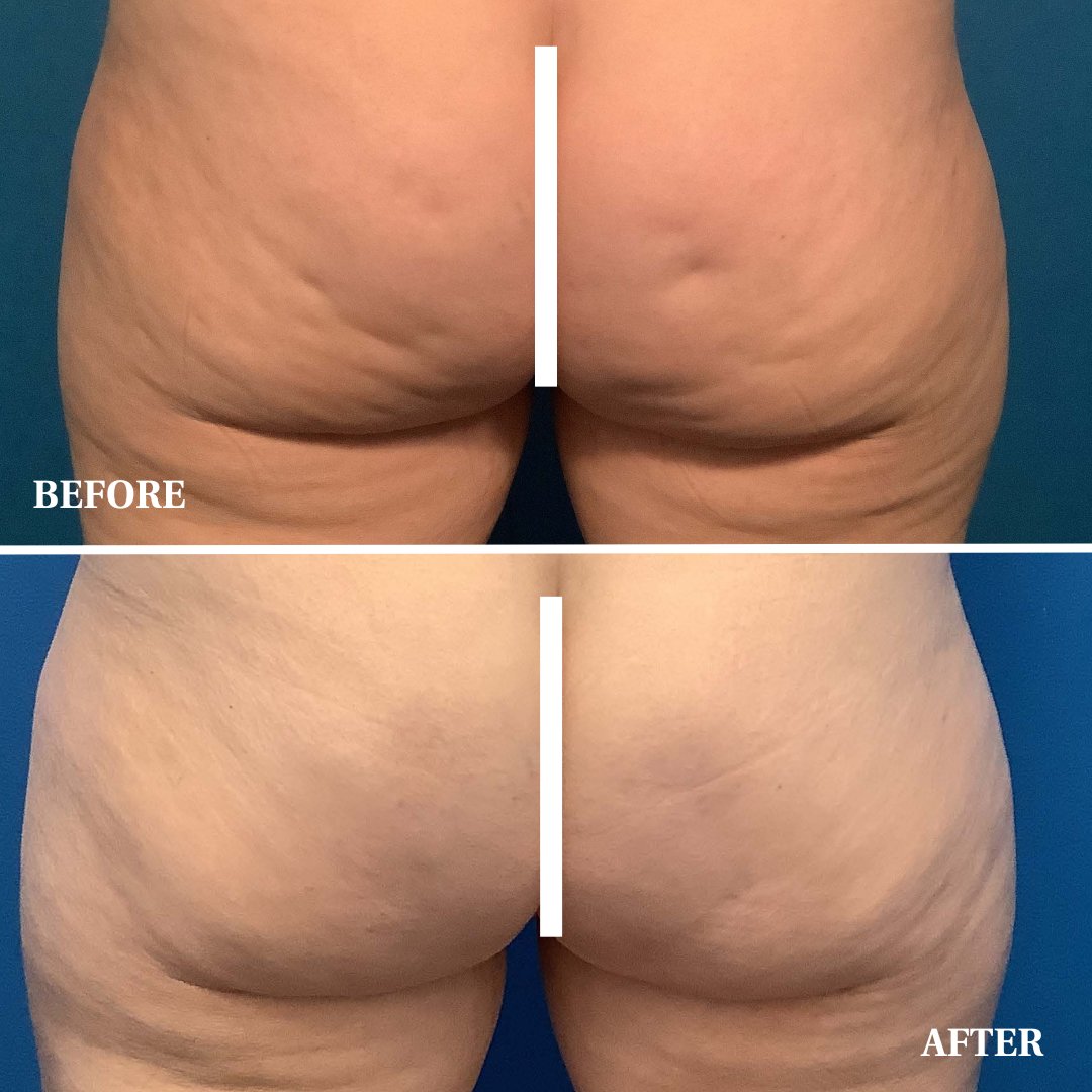Check out these results from Aveli — an FDA device cleared for treating cellulite of the buttocks and posterior and lateral thighs! 😍

•
•
•

#aveli #cellulite #cellulitetreatment #plasticsurgery #beforeandafter #medspa #celluliteremoval  #minnesota #minneapolis #stpaul