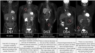 Radiology_AI's tweet photo. Adaptation of language models to the #NuclearMedicine domain improved their performance in predicting Deauville scores in PET/CT reports https://t.co/oYXRICUaWZ @TyBradshaw11 @JunjieHu12 #LLM #RadBERT #AI https://t.co/O4etNNjP8W