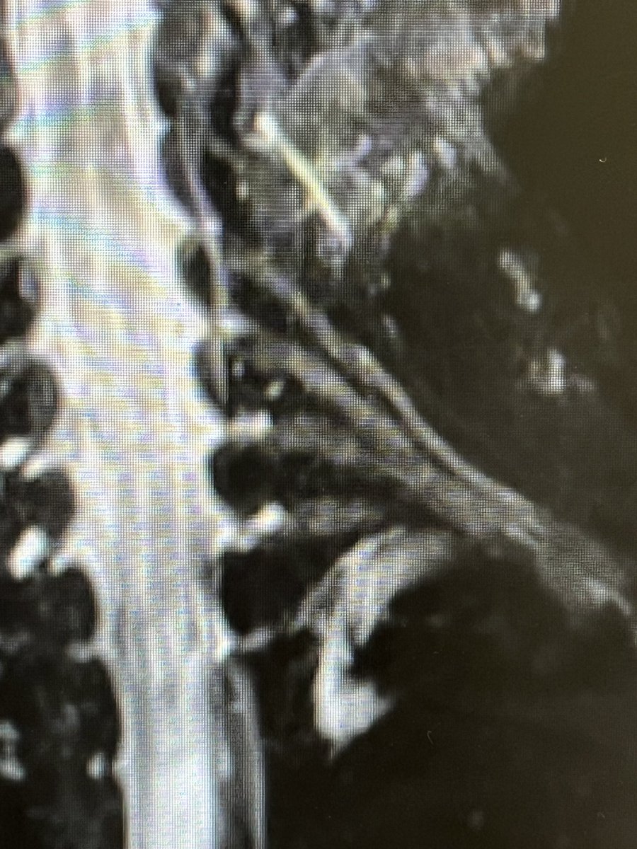 TJQPNI's tweet image. The brachial plexus as imaged with MRI. #Brachialplexus #medicalimaging #MRI