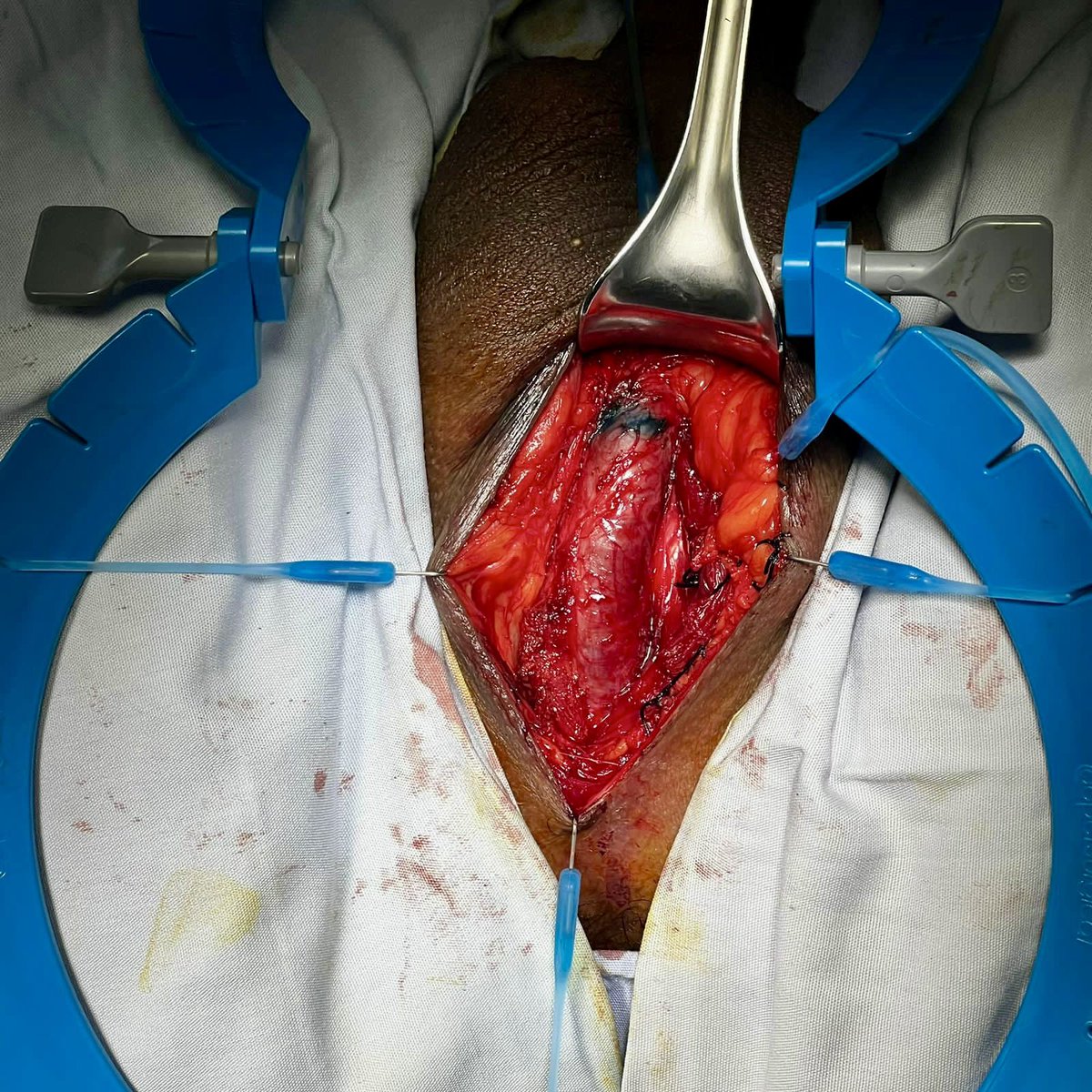 drecabeza's tweet photo. 36a con estrechez uretral post instrumentación, con qmax 2.2 ml/s y 90% OR. Sin UTI previa, por la longitud decidí someterlo a plastia de uretra técnica @sanjaybkulkarni con BMG. Con una disección de planos muy sencilla debido a no tener antecedente de tratamiento. https://t.co/psrmWle9wr