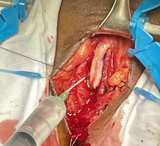 36a con estrechez uretral post instrumentación, con qmax 2.2 ml/s y 90% OR. Sin UTI previa, por la longitud decidí someterlo a plastia de uretra técnica <a href="/sanjaybkulkarni/">Dr Sanjay Kulkarni</a> con BMG. Con una disección de planos muy sencilla debido a no tener antecedente de tratamiento.