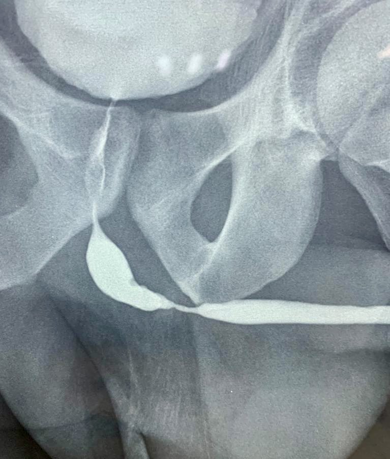 drecabeza's tweet photo. 36a con estrechez uretral post instrumentación, con qmax 2.2 ml/s y 90% OR. Sin UTI previa, por la longitud decidí someterlo a plastia de uretra técnica @sanjaybkulkarni con BMG. Con una disección de planos muy sencilla debido a no tener antecedente de tratamiento. https://t.co/psrmWle9wr