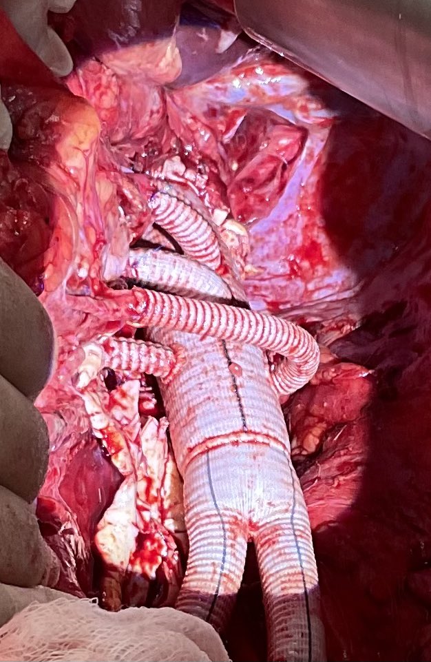 Eleven years ago it was a privilege to implant the 1st Thoraflex Hybrid device in the UK. After 11 years of partnership and collaboration with <a href="/TerumoAortic/">Terumo Aortic</a> it is a privilege to implant the new Thoracoflo system for the 1st time in the Uk. Thanks to our proctor Sabine Wipper.