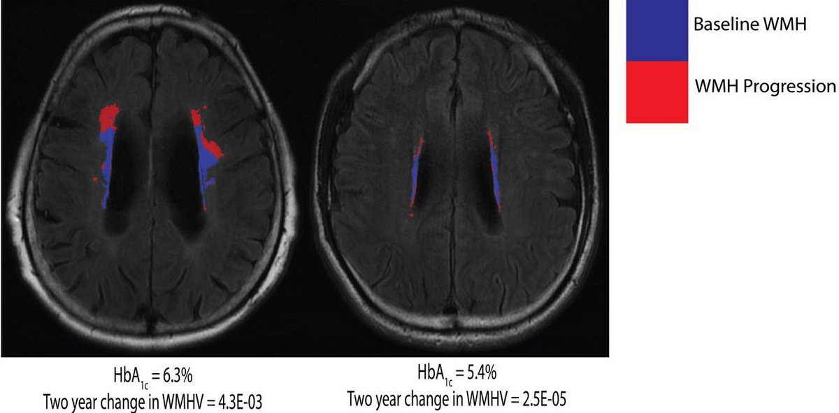 Diabetes_ADA's tweet photo. Higher HbA1c is Associated with Greater Two-Year Progression of White Matter Hyperintensities.

Read Here➡️https://t.co/4jDxW39IOn

@ADA_Pubs https://t.co/Fd6YQUEwgg