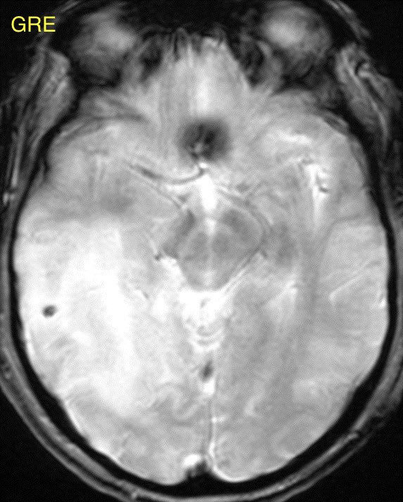 What is the most likely diagnosis in this 75 y/o M w/ history of Alzheimer’s disease on lecanemab (last infusion ~1 week prior) presenting w/ headache and confusion? 🧠 More images in 🧵 #MedEd #Neurology #medicine #radres #Neurosurgery #futureradres @a_charidimou
