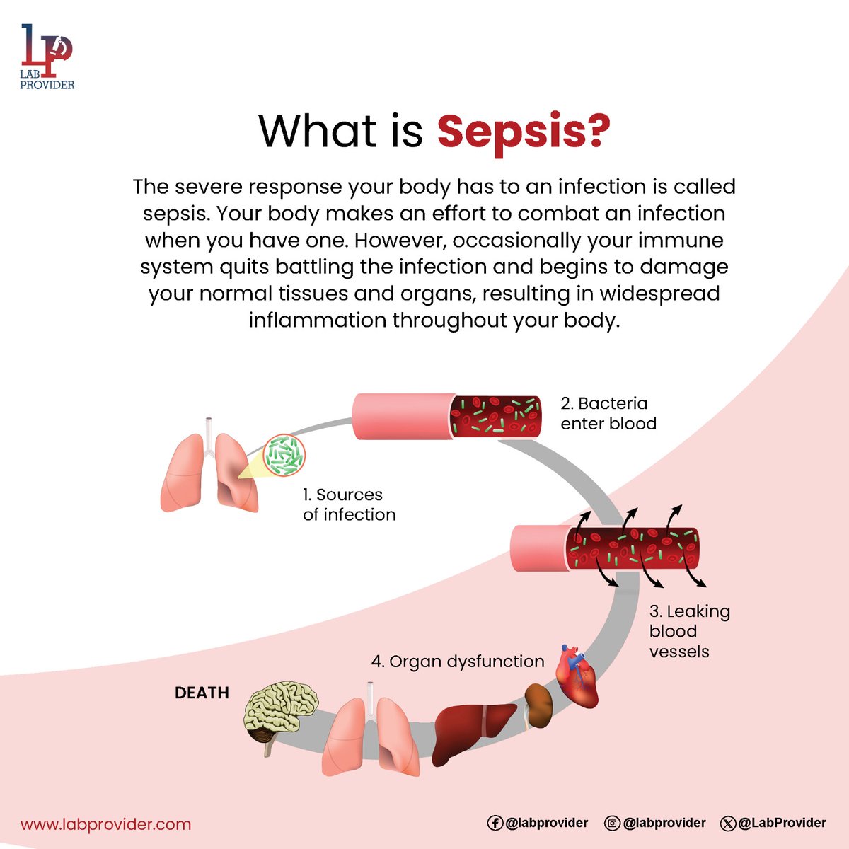 Stop Sepsis, Save Lives!
.
.
.
.
.
#sepsis #infection #organmalfunction #organdamage #lowbloodpressure #liver #lungs #labprovider