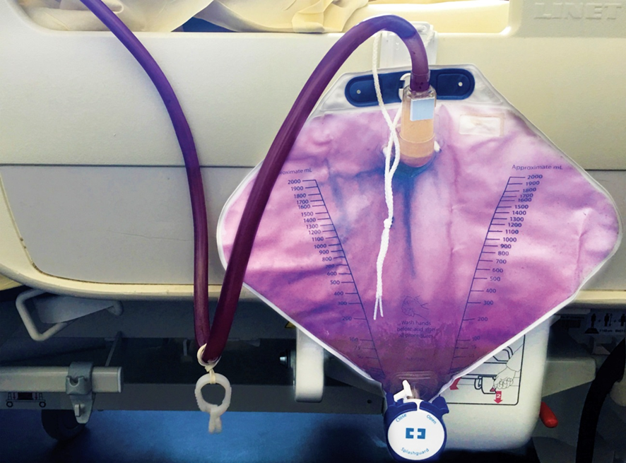 guerreroespejo's tweet photo. 70 años♀️ con catéter urinario durante 10 días por accidente cerebrovascular: su orina tenía un color MORADO. 
El análisis de orina mostró leucocitos y el pH era 8. ¿Puede hacerlo una bacteria?
1/3

DOI: 10.1056/NEJMicm1905446
#infecciosas #microbiología https://t.co/1ByLFFqTA0