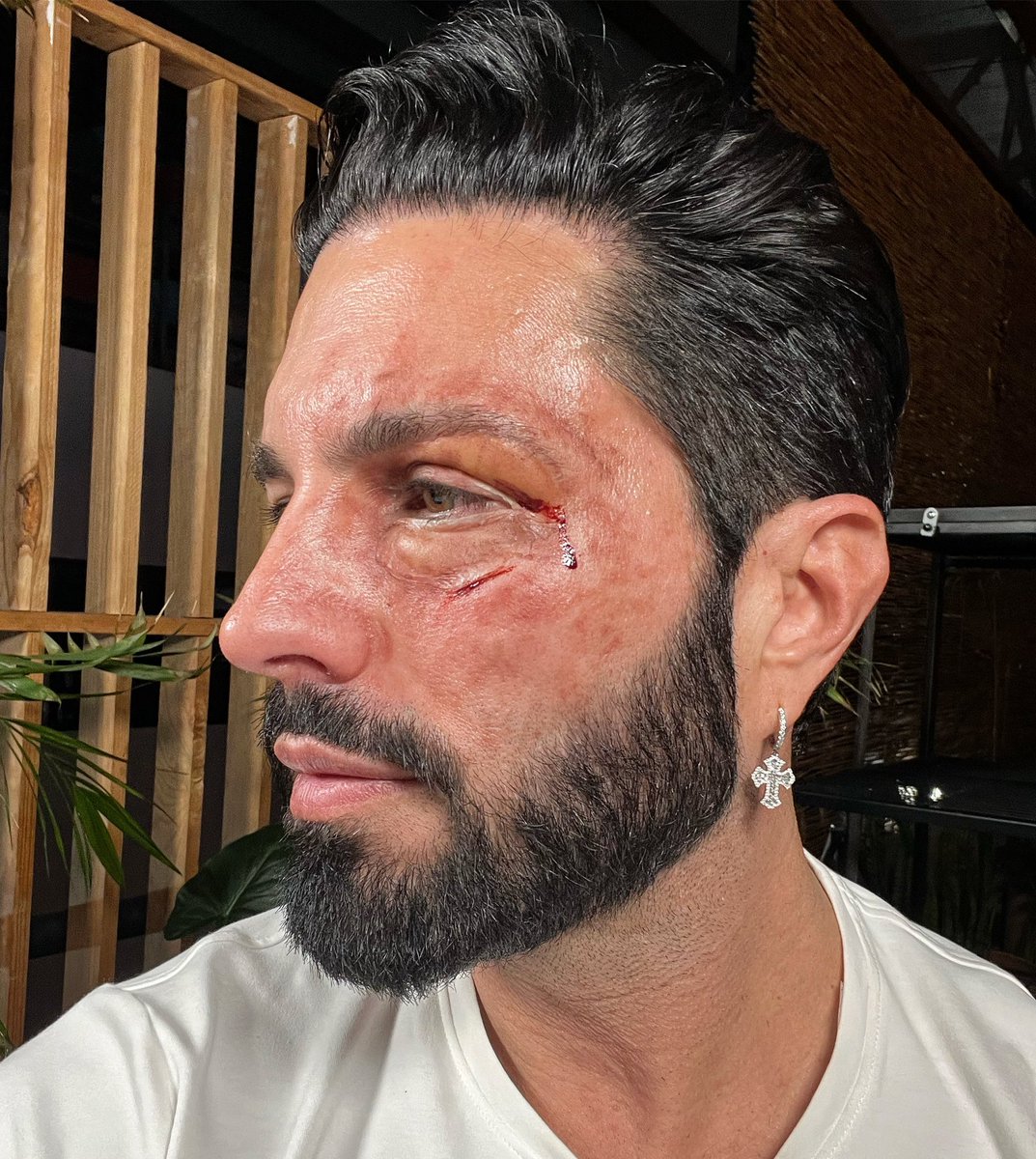 _PonchoDeNigris's tweet photo. Lo bueno fue que la nariz no le la tocaron, de eso Vivo. Gracias a los que están al pendiente. https://t.co/E0aMm2gAOi