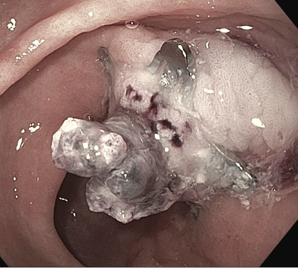 Ayushi Shah (@ayushishahmd) on Twitter photo Successful hemostasis of large bleeding gastric ulcer with a visible vessel using the Padlock Clip system. Always grateful for the expert guidance by <a href="/theganesh/">Ganesh chouhan</a> <a href="/MuzaffarAkbar/">Hafiz Muzaffar Akbar Khan</a> at <a href="/UpstateGastro/">Upstate Gastroenterology</a> <a href="/steris/">STERIS Healthcare United States</a> Successful hemostasis of large bleeding gastric ulcer with a visible vessel using the Padlock Clip system. Always grateful for the expert guidance by <a href="/theganesh/">Ganesh chouhan</a> <a href="/MuzaffarAkbar/">Hafiz Muzaffar Akbar Khan</a> at <a href="/UpstateGastro/">Upstate Gastroenterology</a> <a href="/steris/">STERIS Healthcare United States</a>