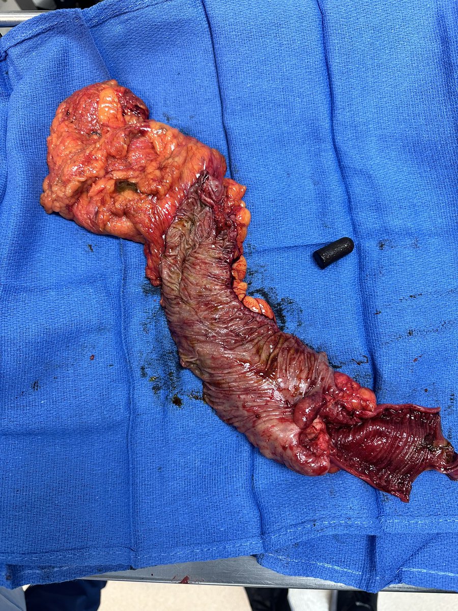 Averywalker21's tweet photo. Doc: Sir, did you lose an ear plug recently
Patient: I had two once and noticed I lost one about a month ago
Doc: I found it
Patient: what???
Doc: shows picture of right hemi colectomy specimen with lost ear plug
Patient: Can I have it back?
😂😂
#mindblown
#interestingfind https://t.co/x1JaA93e1M