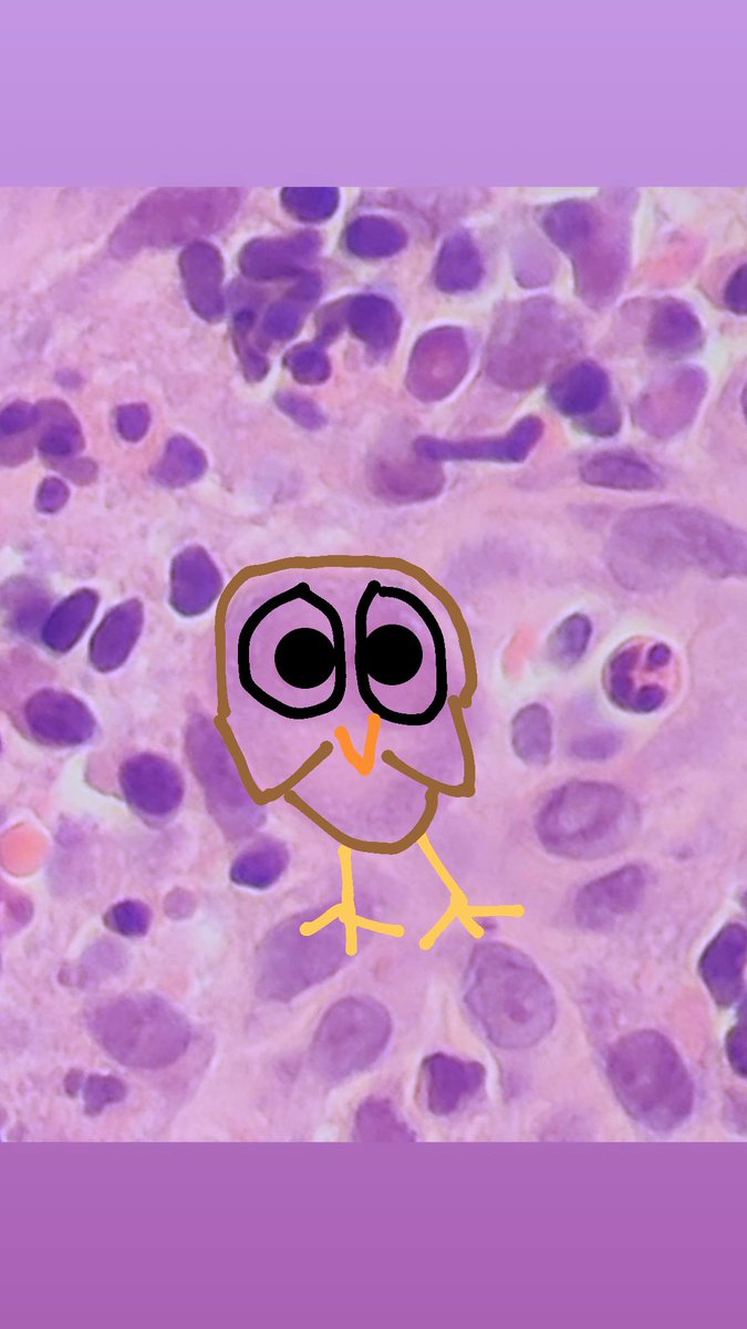 DraEosina's tweet photo. It seems like, sometimes, CMV-infected cells do look like little cute owls... ๐ฆ
#GiPath #Pathology #PathArt #Pathreidolia https://t.co/DH0DEM0dUW
