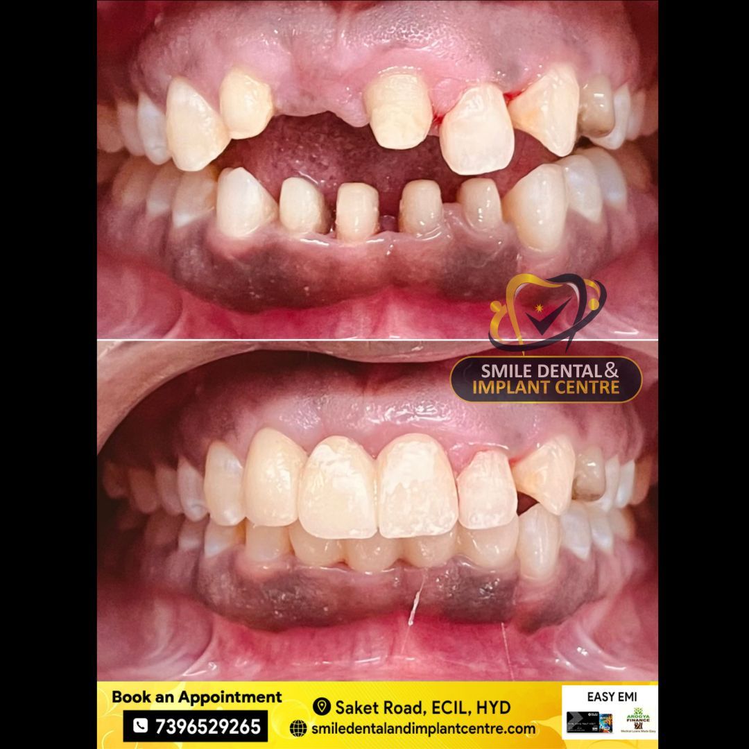 SmileDentaland1's tweet photo. #FixedTeeth: Before and After #ZirconiaCrowns Restoration at #SmileDentalandImplantCentre in #ASRaoNagar, #Hyderabad.

For Appointment call us at +91-7396529265.
More Info Visit: https://t.co/7Aiddja7kq
#zirconiacrown  #zirconia #dentist #smile  #smilemakeover #smiledesign https://t.co/gY7zlNBx8C