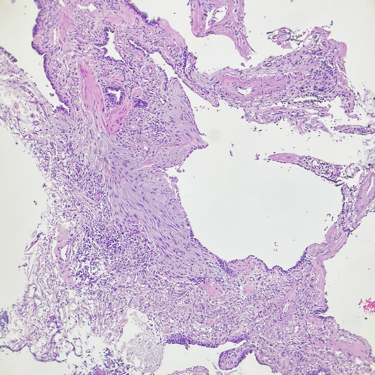 Lung, cryobiopsy 

#FibroblastFocusFriday