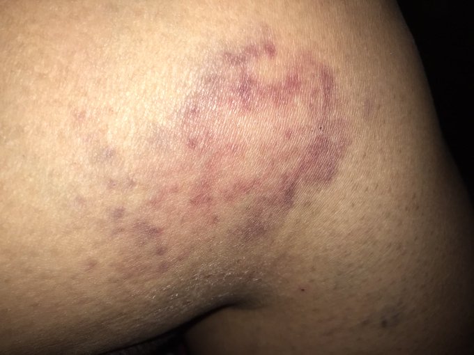 Seattle First Care Responders Saved my Life. They are my heroes. I am so grateful and I do not want to<a href="/tag/crazy"class="tags"><span>#crazy</span></a><a href="/tag/mentalillness"class="tags"><span>#mentalillness</span></a><a href="/tag/mentaldisorder"class="tags"><span>#mentaldisorder</span></a><a href="/tag/damsel"class="tags"><span>#damsel</span></a>