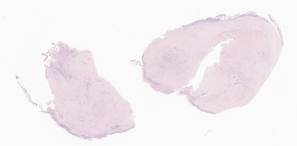 EricMadPatho's tweet photo. 58/M stomach wedge resection. Low power looks like lymphoid cuffing, so schwannoma. Easy, right? Well... high power of the "cuff" sure looks spindle. DOG1+ low power and c-KIT(+) high power shows that it's actually GIST. #GIpath #PathX #pathresidents https://t.co/rzUp8Nzydk