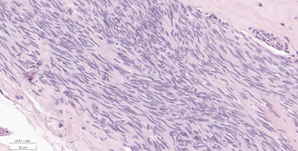 EricMadPatho's tweet photo. 58/M stomach wedge resection. Low power looks like lymphoid cuffing, so schwannoma. Easy, right? Well... high power of the "cuff" sure looks spindle. DOG1+ low power and c-KIT(+) high power shows that it's actually GIST. #GIpath #PathX #pathresidents https://t.co/rzUp8Nzydk