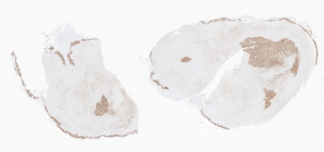 EricMadPatho's tweet photo. 58/M stomach wedge resection. Low power looks like lymphoid cuffing, so schwannoma. Easy, right? Well... high power of the "cuff" sure looks spindle. DOG1+ low power and c-KIT(+) high power shows that it's actually GIST. #GIpath #PathX #pathresidents https://t.co/rzUp8Nzydk