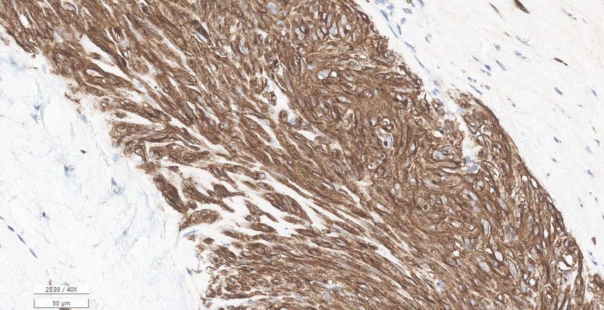 EricMadPatho's tweet photo. 58/M stomach wedge resection. Low power looks like lymphoid cuffing, so schwannoma. Easy, right? Well... high power of the "cuff" sure looks spindle. DOG1+ low power and c-KIT(+) high power shows that it's actually GIST. #GIpath #PathX #pathresidents https://t.co/rzUp8Nzydk