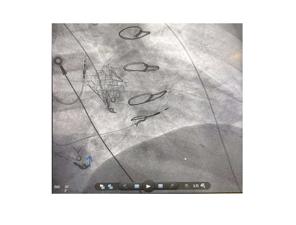 EPLabDigest's tweet photo. EPLD's most-read article of 2023!

Left Bundle Branch Area Pacing: Techniques and Troubleshooting

@naijaQRS and @ogadeola1 review pace mapping and anatomical-based implantation techniques, and discuss troubleshooting during lead implantation.
https://t.co/KWDb7hr0h3 https://t.co/40deEkhv6R