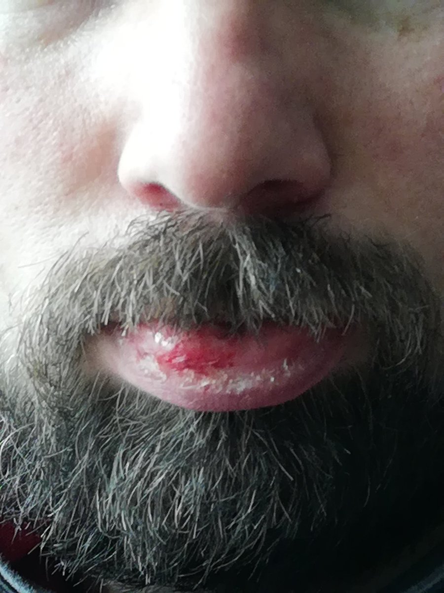 Mann hat ja sonnst nichts zu tun auf Arbeit, außer sich mit einem 25kg zuckersack die Unterlippe aufzuschlagen. 🤷‍♂️