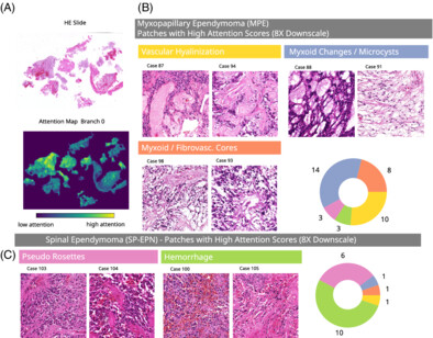 brainpathol's tweet photo. Morphology-based molecular classification of spinal cord #ependymomas using deep neural networks
#neuropath #ai #computationalpathology
@Julia_E_Neumann @ulrichschueller 
https://t.co/9CQfhNqLKA https://t.co/V2exkHr7Lp