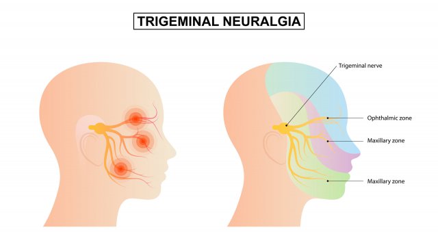 Dt_Aerzteblatt's tweet photo. Neue S1-Leitlinie Trigeminusneuralgie erschienen: München – In den vergangenen Jahren haben neue Erkentnisse zur Pathophysiologie der Trigeminusneuralgie zur Änderung der Klassifizierung geführt. Daraufhin sei es an der Zeit… https://t.co/QXU8RAu6U2 #DMKG #Leitlinie https://t.co/FSRoKnXp8c