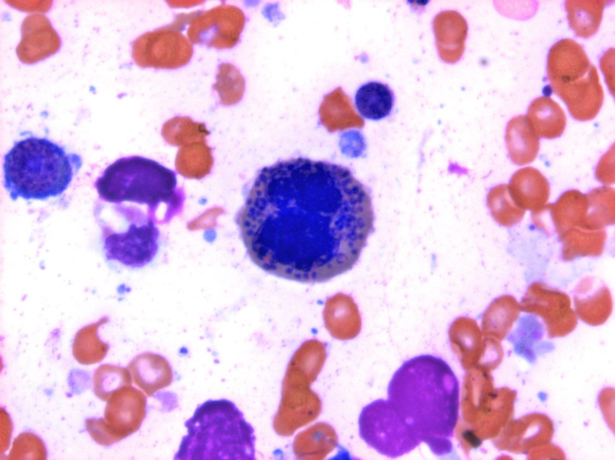 #hemepath MDS. Can you think of all the kinds or erythroid dyspoiesis you can see? Start here