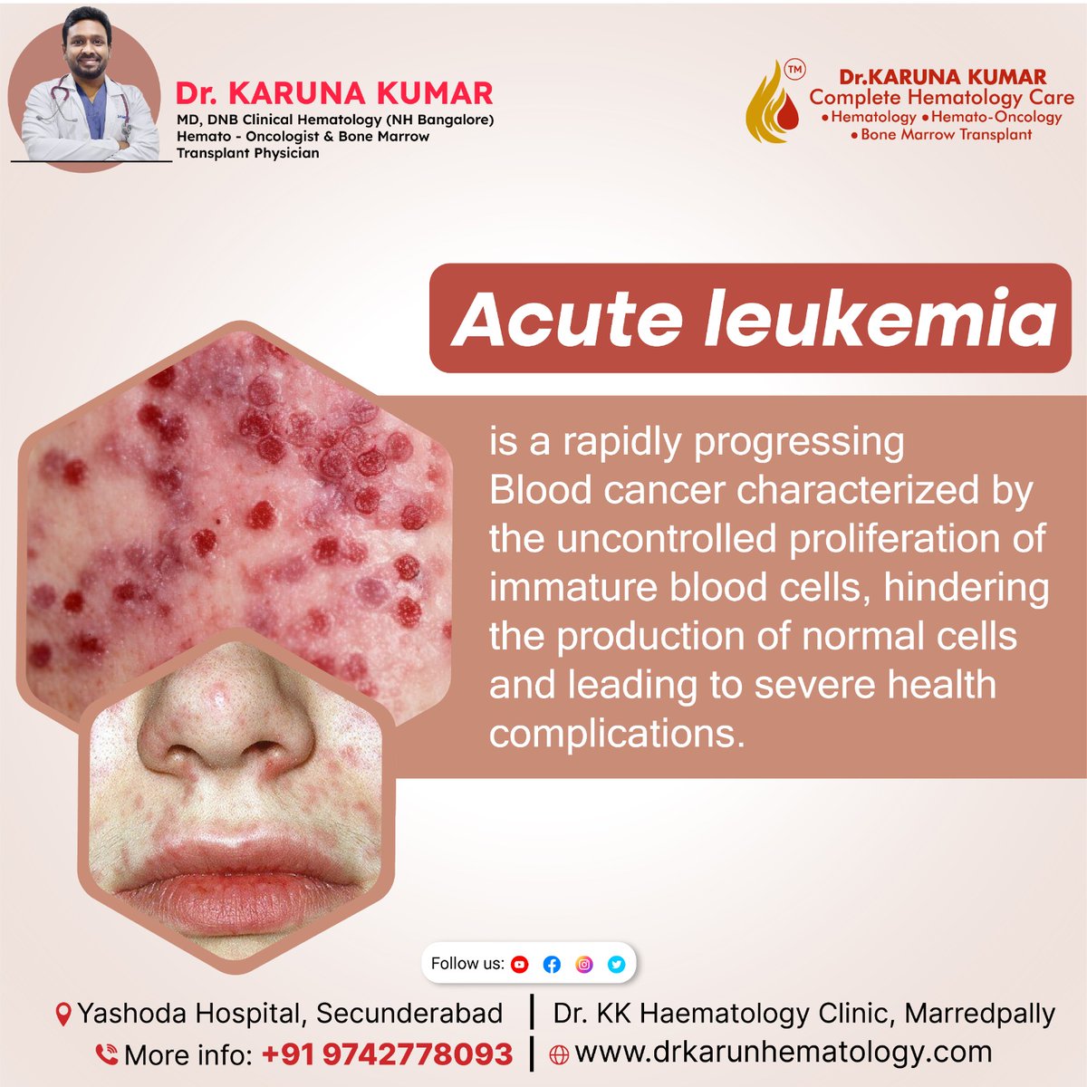 Diving into the world of acute leukemia: A swift and intense blood battle where immature cells take center stage. Unveiling the challenges of a rapidly changing health landscape.
.
.
.
#AcuteLeukemiaAwareness #BloodCancerFight #LeukemiaWarrior #RapidHealthBattle #CancerUnveiled