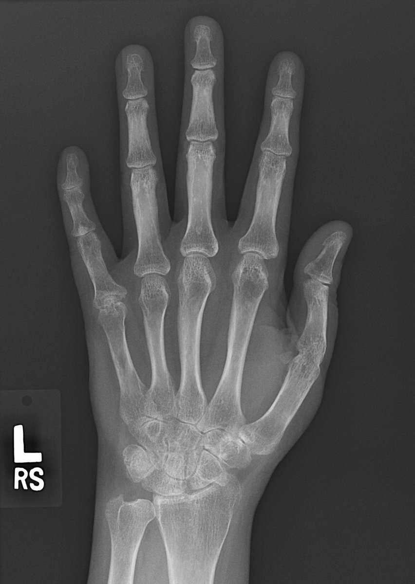 UW_MSKrad's tweet photo. #CaseOfTheWeek‼️🥳‼️
☢️🩻☠️Case#2☠️🩻☢️
#3Patients #SameDisease
➡️➡️📲#Diagnosis❓❔❓
#FOAMrad #RadEd #MedEd #OrthoEd #OrthoTwitter @ssr_rwg @UWRadRes @ACRheum https://t.co/JnN4AQMwO0