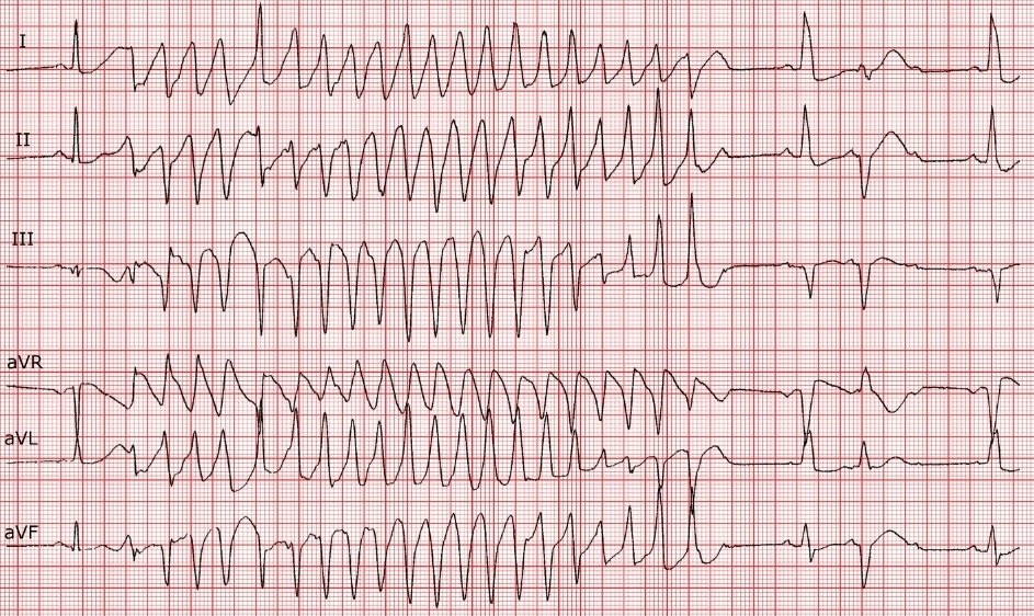 71yrs Male brought by ambulance to ED. He complains of Palpitations BP 74/45mmHg Potassium = 1.5 mEq/L 1. Diagnosis ? 2. Immidiate Treatment ? 3. Work-up ?