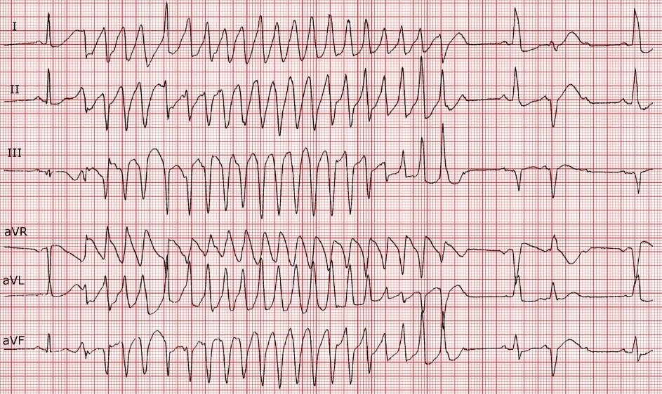walinjom's tweet photo. 71yrs Male brought by ambulance 
 to ED.
He complains of Palpitations 
BP 74/45mmHg 
Potassium = 1.5  mEq/L 

1. Diagnosis ?
2. Immidiate Treatment ?
3.  Work-up ? https://t.co/2pO3wCLxzo
