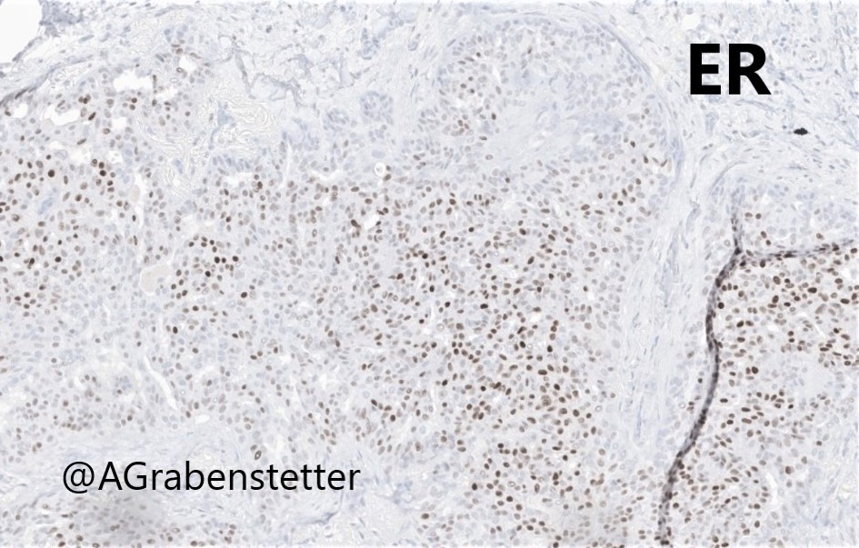 Breast snapshot: UDH with necrosis 👀🔬 #bcsm #pathology #PathTwitter ⚠️Necrosis does not automatically = malignant⚠️ While rare, the presence of necrosis does not preclude a diagnosis of UDH if the architectural and cytologic features of the proliferation support that dx