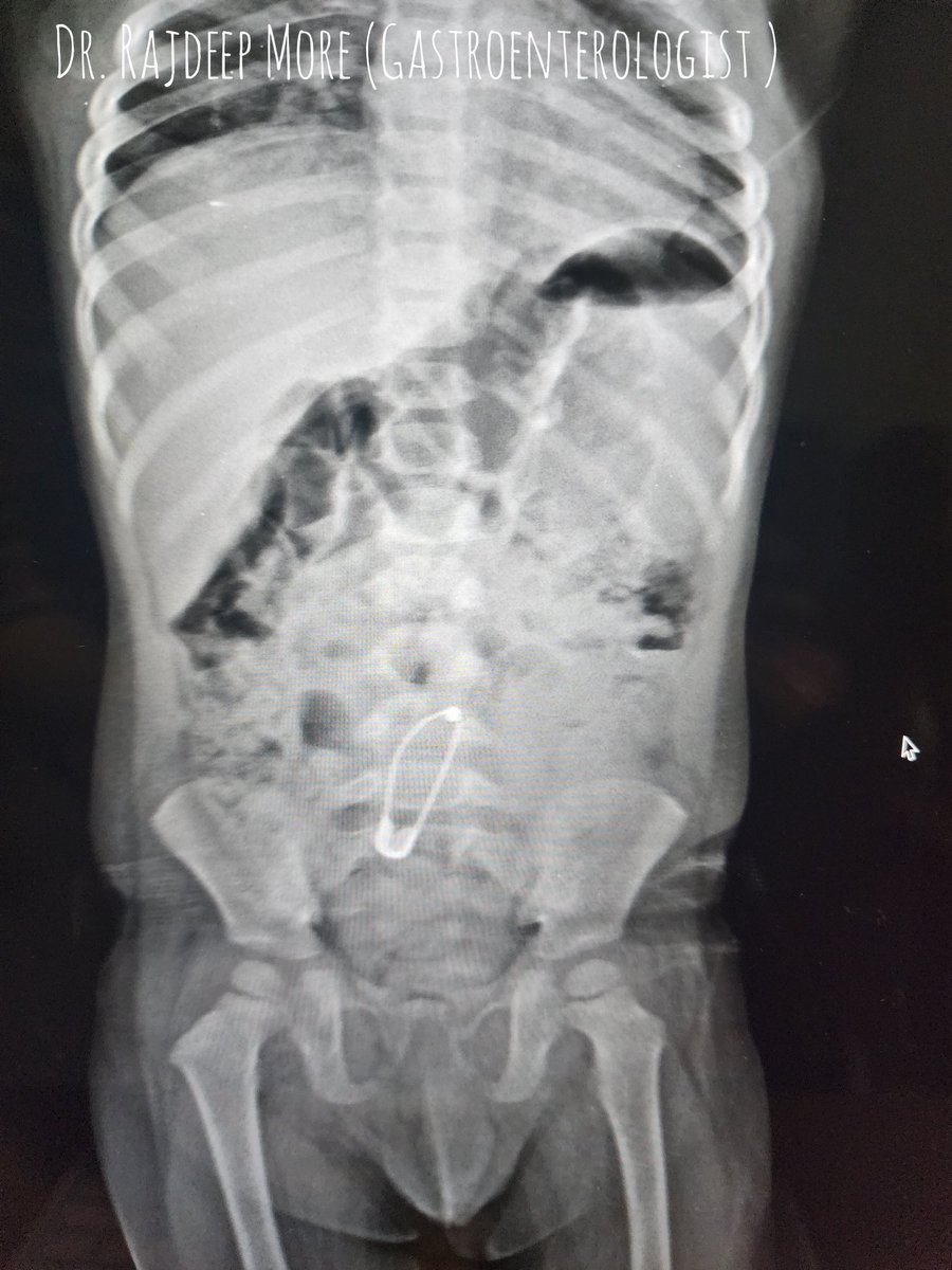 morerajdeep's tweet photo. The horror u don't want to see when u turn up for work🔥😥.
Swallowed safety pin reached the 
?sigmoid colon.
Did sigmoidoscopy but couldn't visualise the pin due to stool (pin probably wrapped in stool).
Asymptomatic 1yr old child .
Thoughts? @drkeithsiau @stevenbollipo #GITwitter