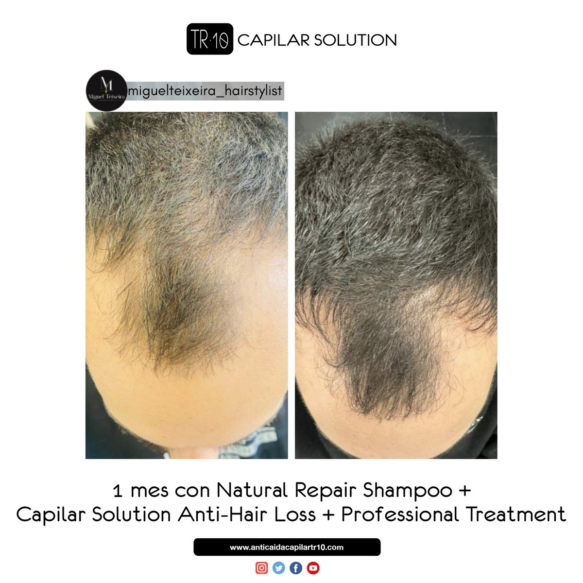 tr10_capilar's tweet photo. Nos vamos al fin de semana con un caso de éxito de nuestros hermanos portugueses... 👏👏👏
1 mes con TR10 Capilar Solution Anti-Hair Loss, TR10 Natural Repair Shampoo y TR10 Professional Treatment 😎😎😎
¡Gracias @migueltexeira_hairstylist!

#TR10 #TR10funciona #TR10convence https://t.co/BZxnbdRXz9