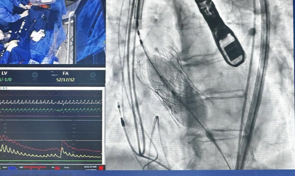 Amazing redo #TAVR live case #SHA2024 @MBalghith @ccclivecases @MountSinaiNYC @MountSinaiHeart @IcahnMountSinai by @DoctorKini @KHERA_MD & our ❤️team of 23S3U Resilia in 29 Evolut for severe PVL. 👏🏼 @bapat_savrtavr @Miho_Fukui_ for the analysis! @LucySafi @Asaadakbarkhan