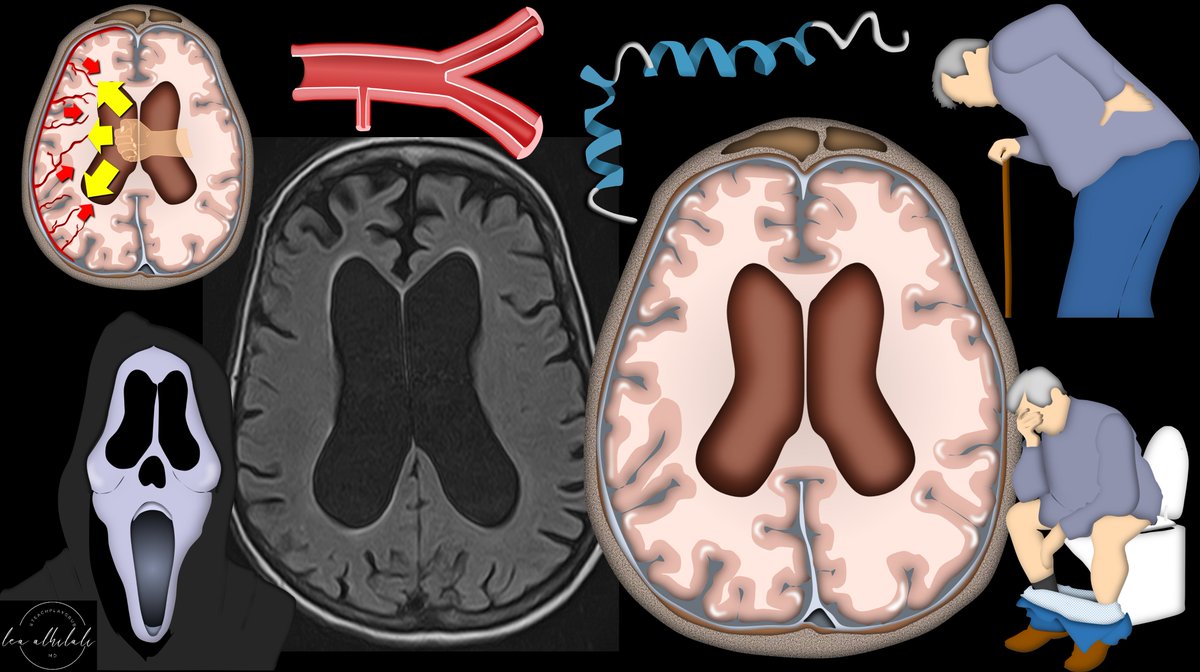 1/To call it or not to call it? That is the question! Do you feel a bit wacky & wobbly when it comes to calling normal pressure hydrocephalus on imaging? You don’t want to overcall it, but you don’t want to miss it either! Let me help you out w/a thread about imaging in NPH!