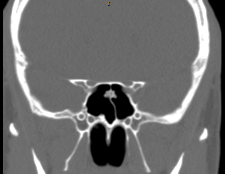 DrScottFortune's tweet photo. Incidental finding on #SinusCTscan #starburst #sphenoidsinus #Osteoma #SphenoidSeptalSpur #Rhinology #RhinologyImaging #CTscan https://t.co/eBkQhnKnV4
