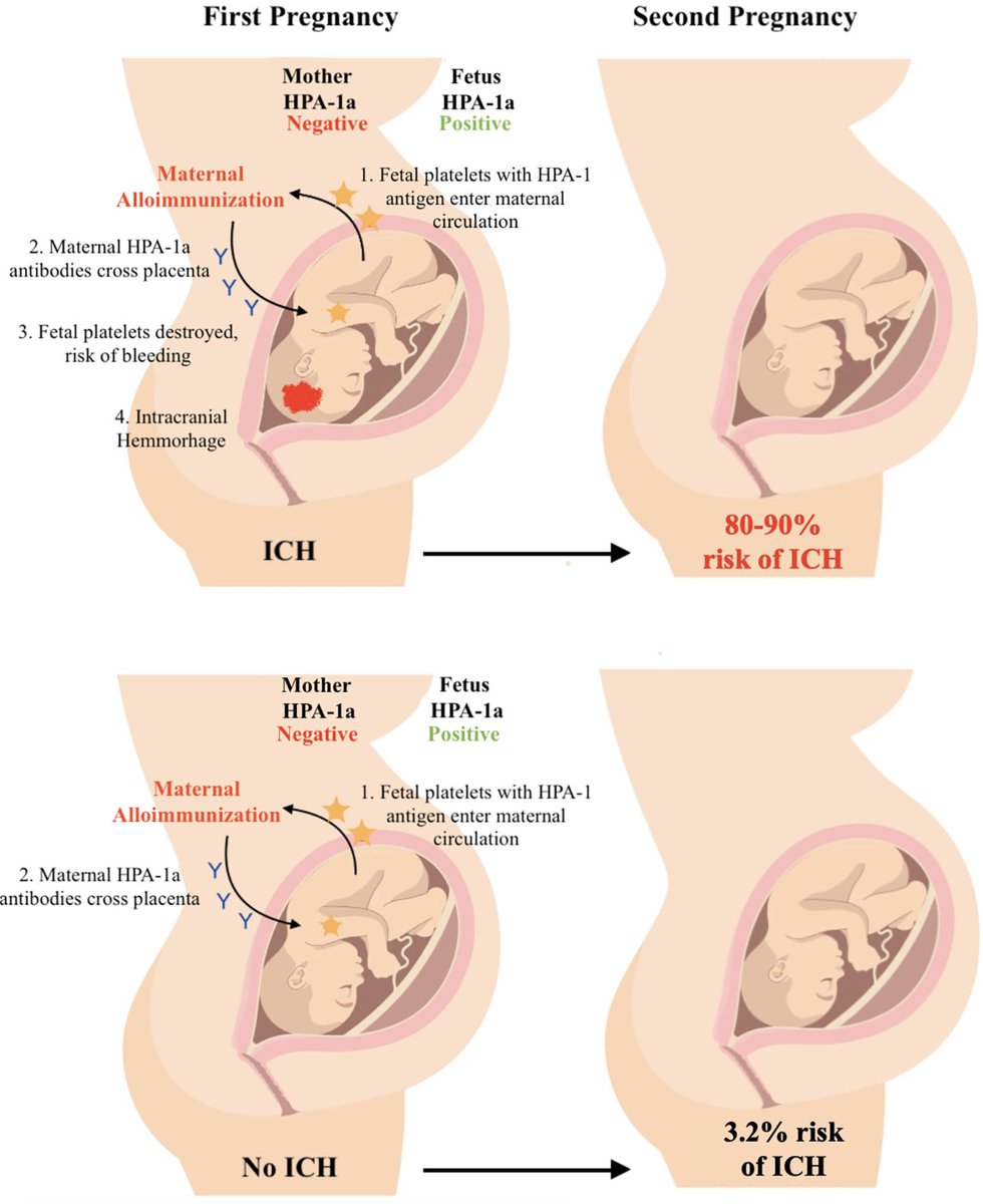 ProfMakris's tweet photo. In Neonatal Alloimmune Thrombocytopenia, if the first baby had an intracranial hemorrhage (ICH) the likelihood of the second having the same was 80-90%. However, if the first baby did not have ICH, the risk to the second is markedly lower at 3.2%. https://t.co/bsQ8b8KzqC #pregnancy